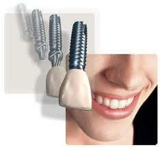 Răng implant nha khoa