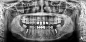 Phim chụp khi cấy ghép implant nha khoa