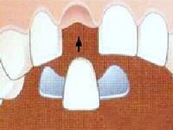 Cầu dán-Làm răng giả