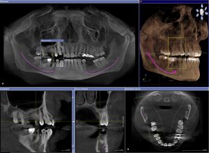 Phim chụp cắt lớp trước cấy ghép implant nha khoa