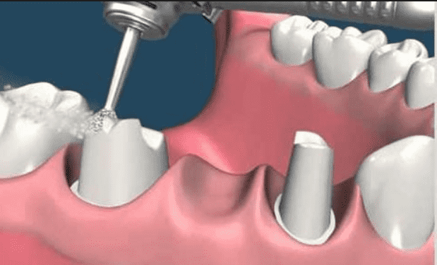 Mão răng sứ- Giải pháp phục hình bằng răng sứ