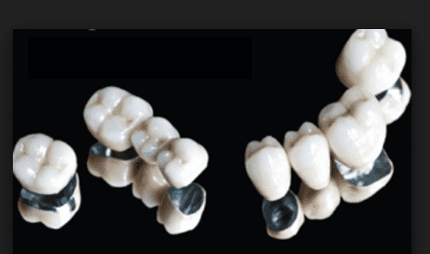 Phục hình răng bằng răng sứ Titan