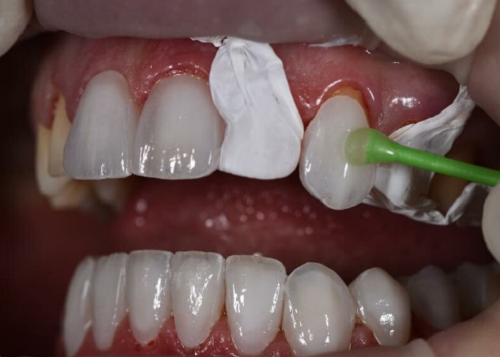 Bọc răng sứ để cải thiện tình trạng hô