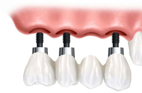 Răng Implant là như thế nào – Có nên trồng răng implant không