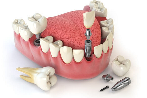 Hình ảnh cấy ghép răng implant