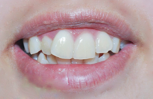 Răng cửa bị chìa nhẹ có thể cải thiện bằng phương pháp bọc răng sứ