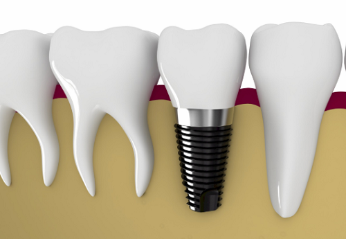 Trụ răng implant được cấy vào xương hàm
