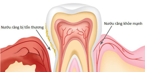 Hình minh họa viêm nướu răng
