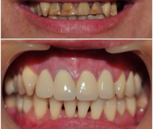 Tìm hiểu răng sứ titan là gì – Có nên bọc răng sứ titan không ?