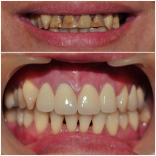 Hình ảnh trước và sau khi làm răng sứ titan tại Nha khoa Hoàng Bảo