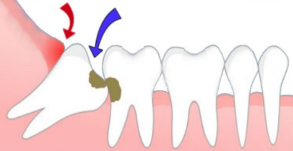 Răng khôn mọc trong hàm