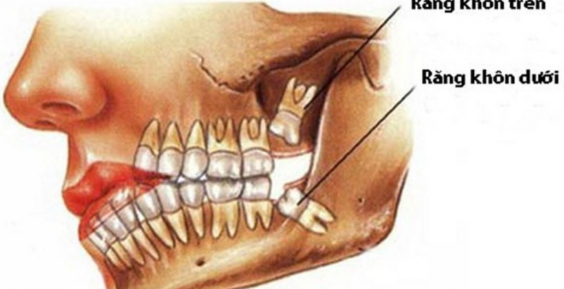 Răng khôn là gì ? Nhổ răng khôn ở đâu