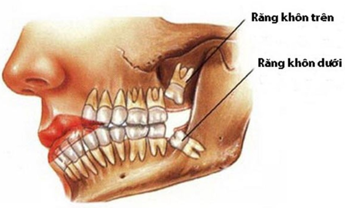 Răng khôn mọc trên và dưới hàm
