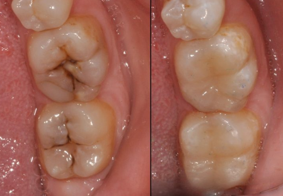 Sâu răng là gì? Nguyên nhân hình thành sâu răng?
