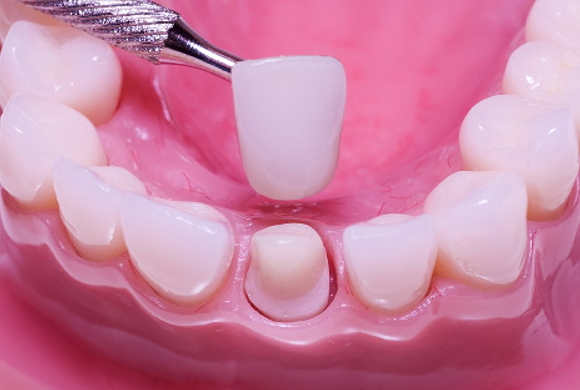 Công nghệ bọc răng sứ có tác hại gì không?