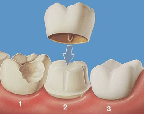 Răng kim loại hay răng toàn sứ 