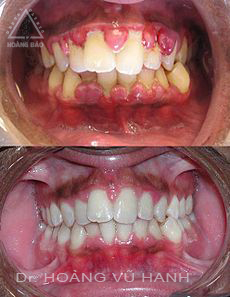 Chửa trị viêm nướu răng tại NK Hoàng Bảo