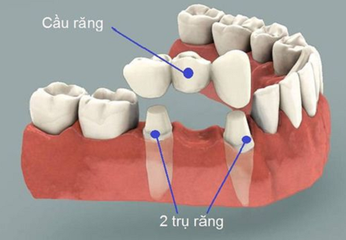 So sánh giữa làm răng implant và cầu răng – Ưu nhược điểm ra sao