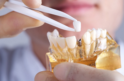4 điều quan trọng bạn cần phải lưu ý khi trồng răng implant giá rẻ