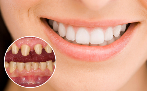 Bọc răng sứ: Công nghệ – Lợi ích- Tác hại khi lắp răng sứ