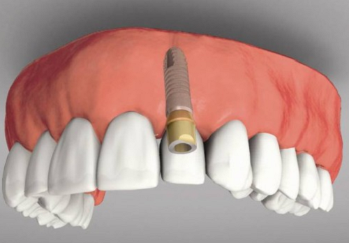 lưu-ý-khi-trồng-răng-implant