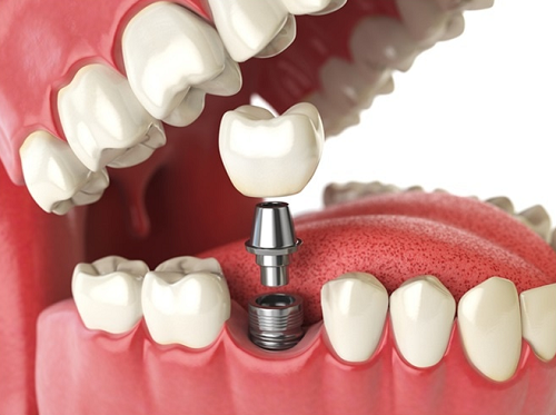 Hình ảnh mô phỏng răng implant