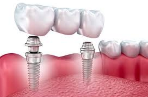 Trồng răng implant có bền không – So sánh với các loại răng khác