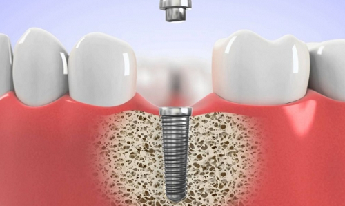 răng-implant-có-bền-không-01