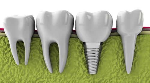 răng-implant-có-bền-không