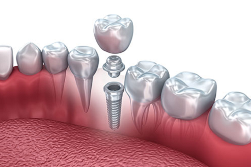 Cấu trúc của trụ răng implant
