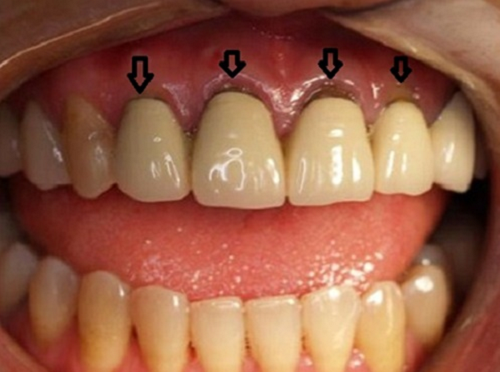 Làm lại răng sứ – Chú ý để đảm bảo sức khoẻ răng miệng