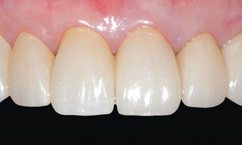 Răng sứ sẽ được thực hiện dựa trên màu sắc và hình dáng của răng thật
