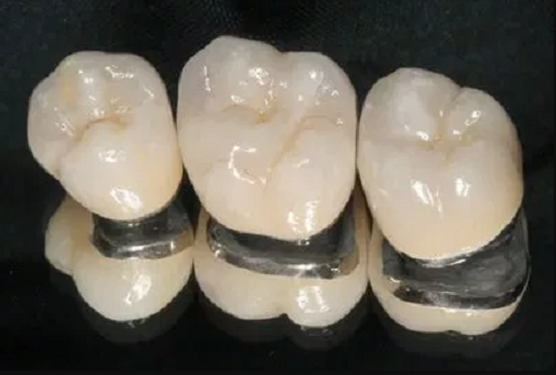Răng sứ kim loại