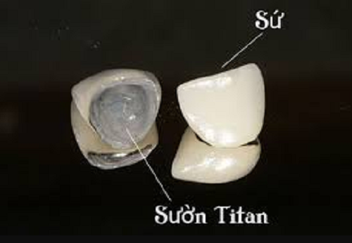 răng-titan