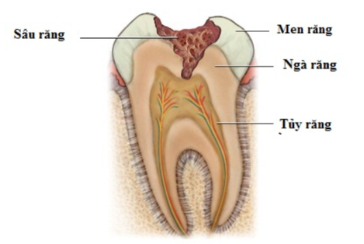 sâu răng là gì