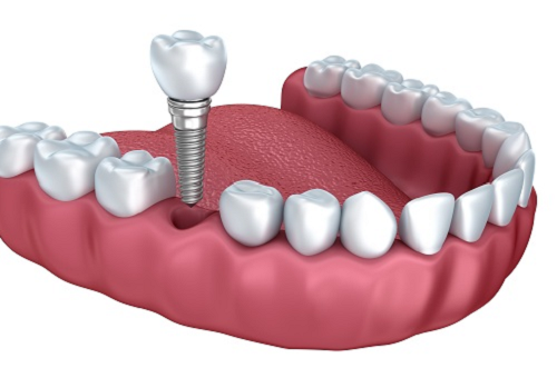 Trụ răng abutment - khi làm răng implant