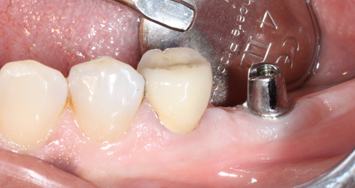 Kinh nghiệm trồng răng implant – 3 điều bạn nên làm rõ với Nha sĩ