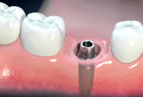 Trồng răng implant có nguy hiểm không – Hỏi đáp cùng nha sĩ