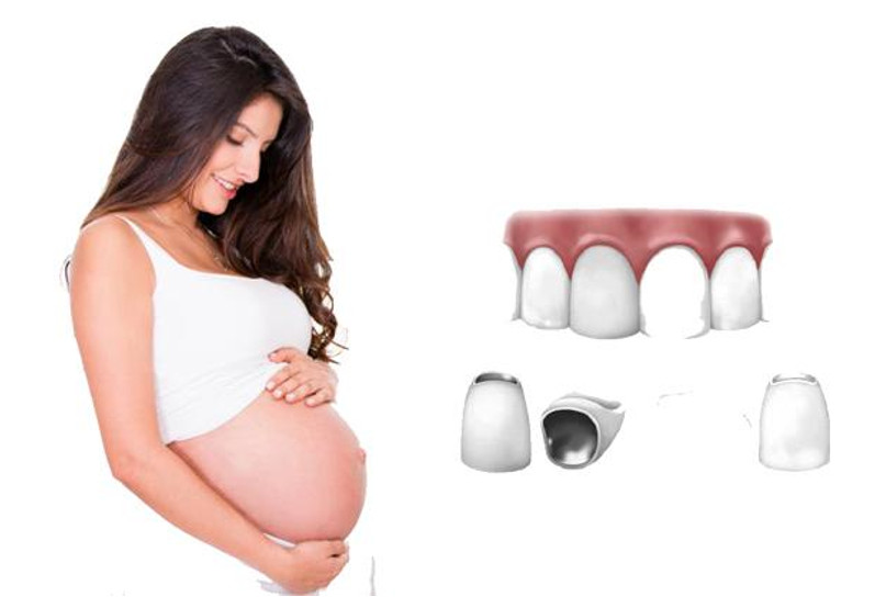 Bọc răng sứ khi mang thai