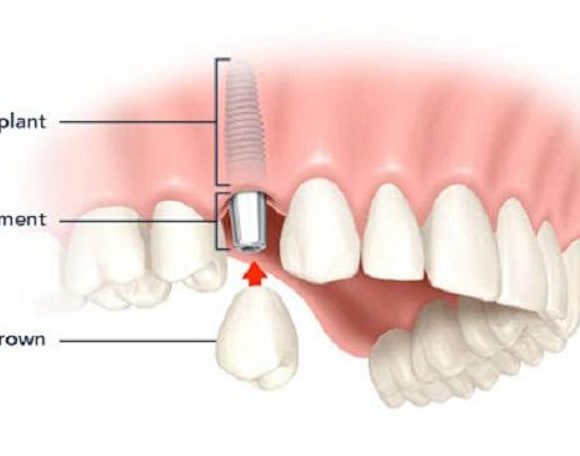Tổng quan về kỹ thuật cấy ghép răng implant hiện đại