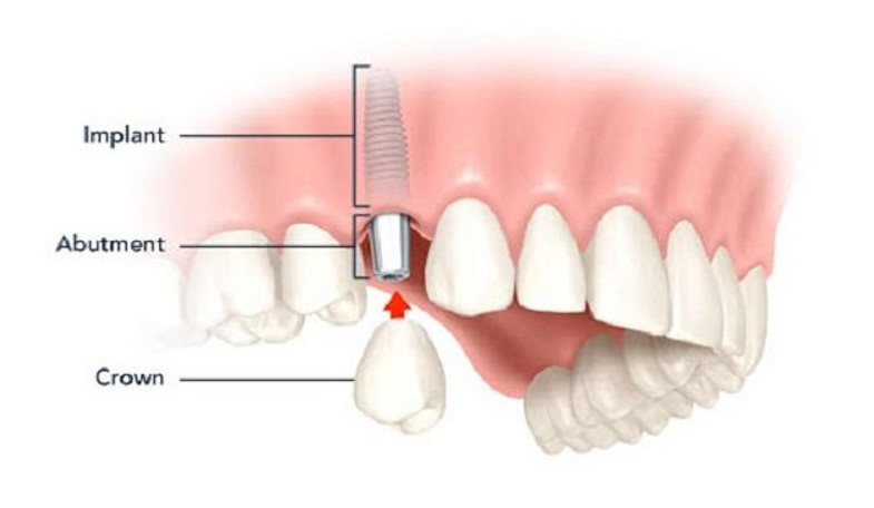 Kỹ thuật cấy ghép răng implant