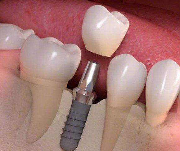 Làm răng implant mất bao lâu và có ưu điểm gì?