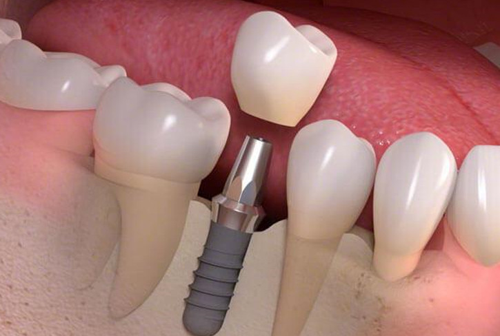 Làm răng implant