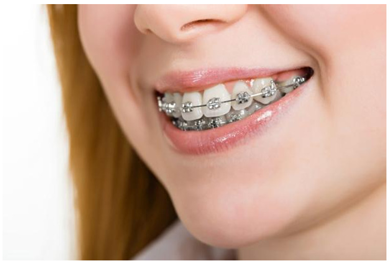 Niềng răng đau không là câu hỏi khiến nhiều khách hàng thắc mắc