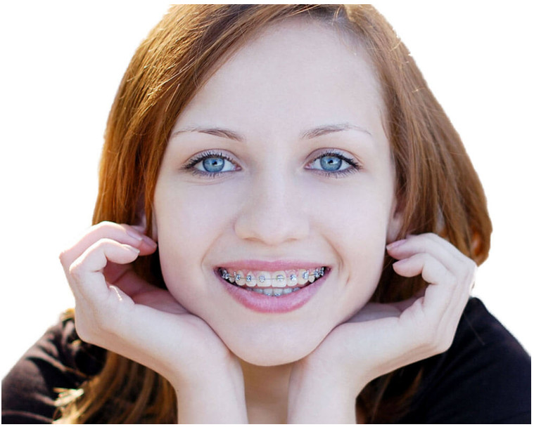 Niềng răng giúp gương mặt cân đối và hài hòa hơn