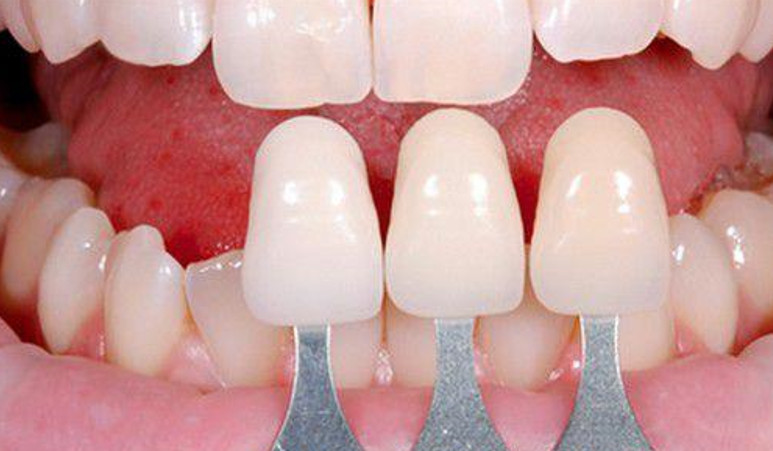 Bọc răng sứ không cần mài răng
