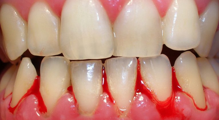 Giải đáp thắc mắc bọc răng sứ bị viêm lợi, hôi miệng phải làm sao?
