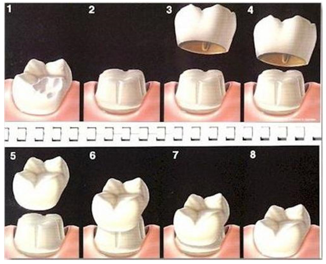 Các bước chế tác bọc răng sứ