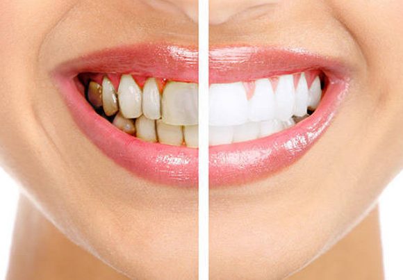 Có nên tẩy trắng răng hay không? Có những phương pháp tẩy trắng nào?