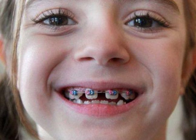 Niềng răng – giải pháp tối ưu cho hàm răng đẹp
